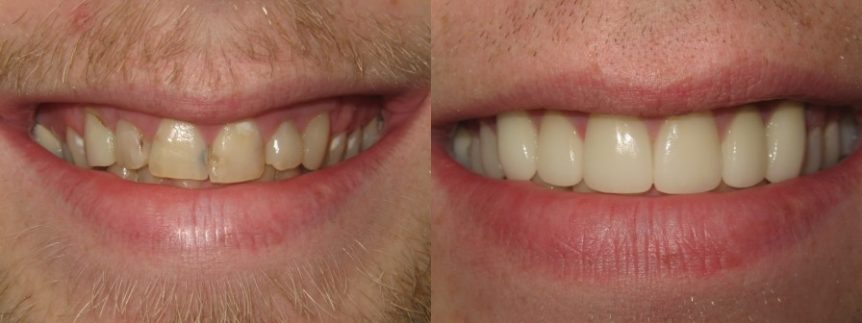 63249018d17ab-laminates_of_decaying_tooth.jpg