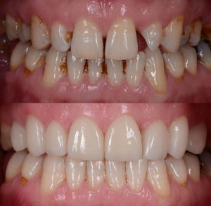 63249018d19e5-laminates_for_spacing_teeth.jpg