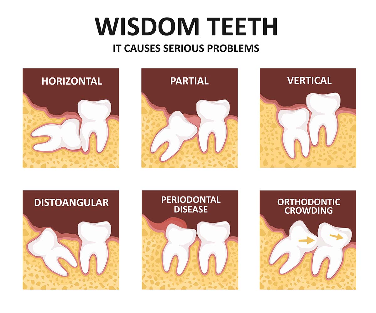 632499c69efcd-wisdom_teeth_issues.jpg