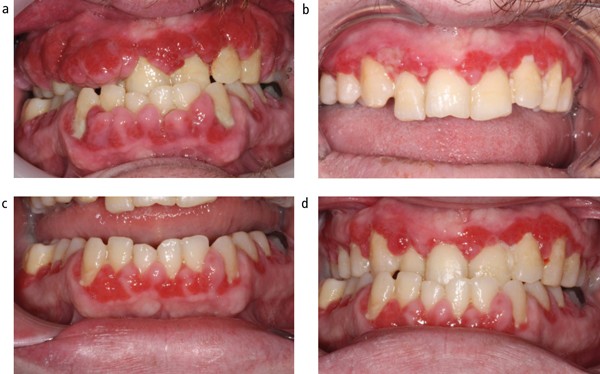 63249b5718dfc-gingival_growth.jpg