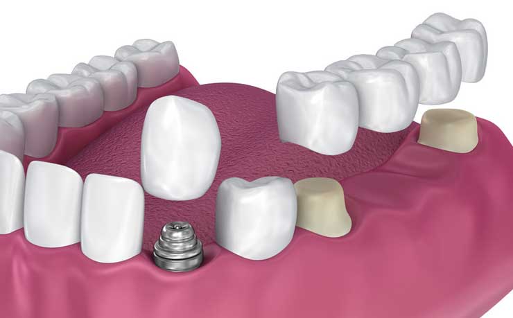 632f1471434f5-prosthodontic_procedures.jpg
