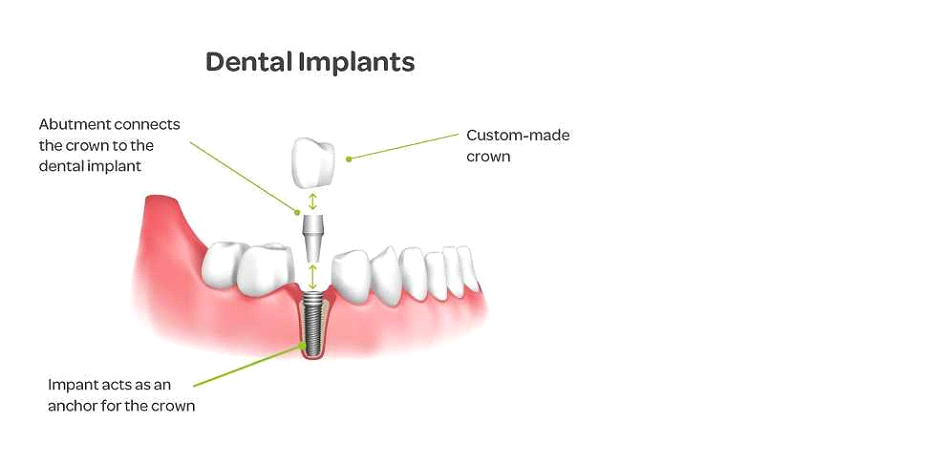 656d8fe127b6e-implant.png