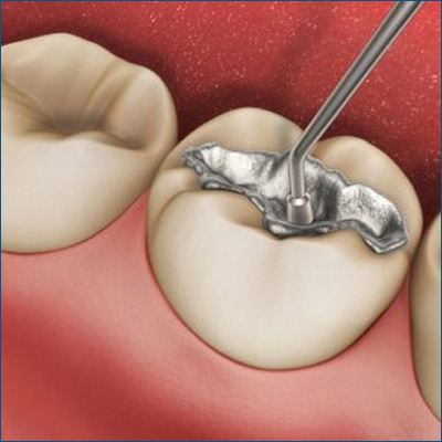 656d953c47d9a-Dental-Filling.jpg