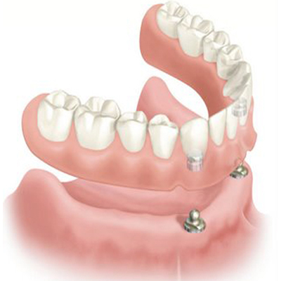 656dbd90736c6-Dentures.jpg