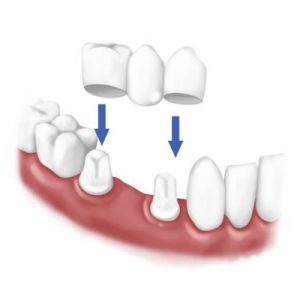 657058f2cee15-Implant_Support_bridge.jpg