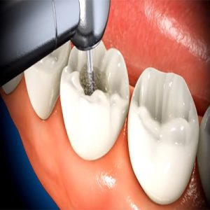 6570595fdbd83-root_canal.jpg