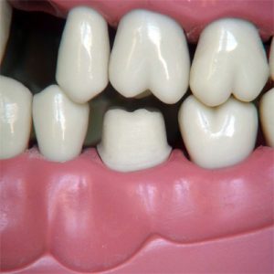 657059cd0922f-Bridge_crown.jpg