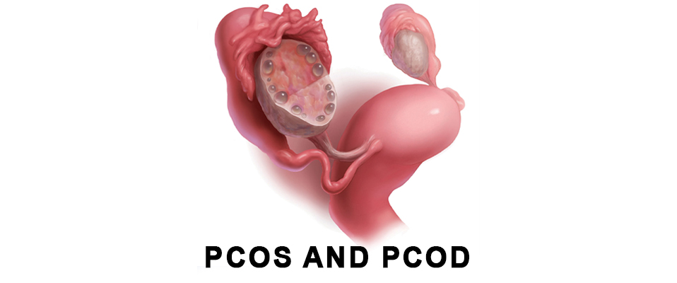 68b048a8ee808-PCOS-and-PCOD.jpg